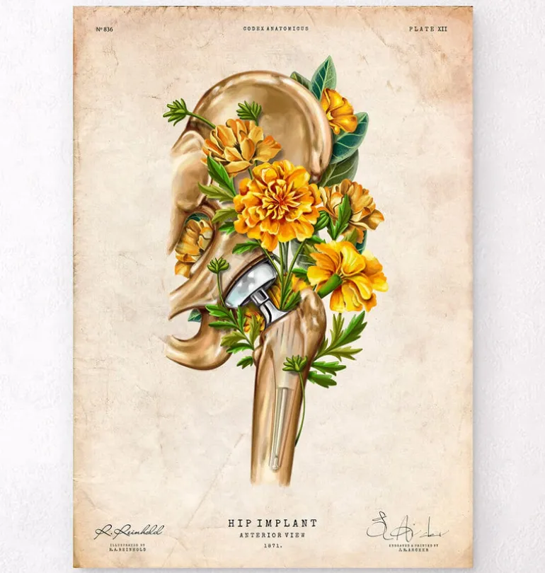 Prothèse totale de hanche - Floral - Vintage